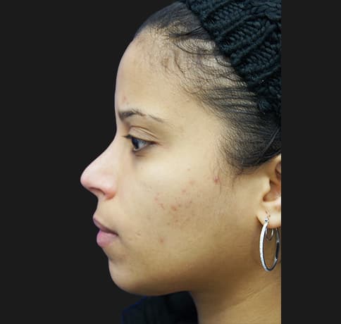 Case 21237 , Performed By Dr. Tehrani – angle 4 After