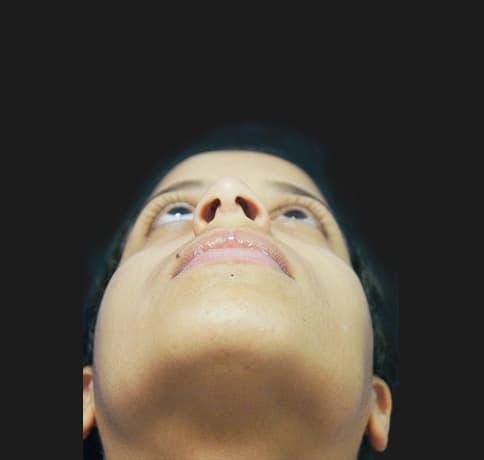 Case 21237 , Performed By Dr. Tehrani – angle 4 Before