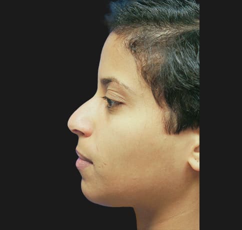 Case 21237 , Performed By Dr. Tehrani – angle 5 Before
