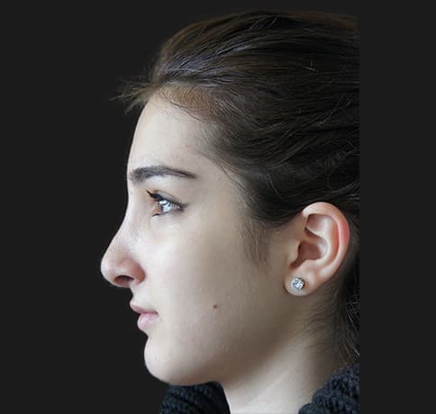 Case 24288 , Performed By Dr. Tehrani – angle 2 After