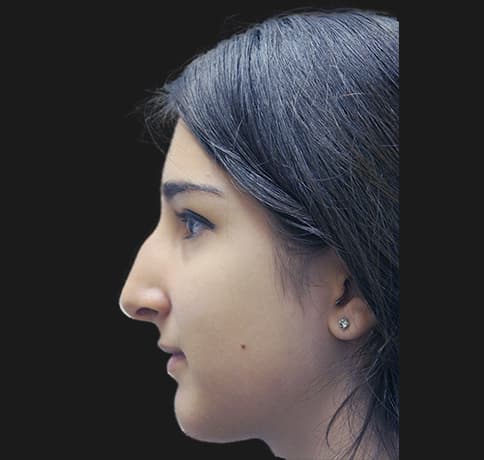 Case 24288 , Performed By Dr. Tehrani – angle 2 Before