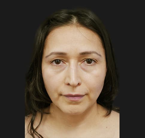 Case 12767 , Performed By Dr. Tehrani – angle 3 After
