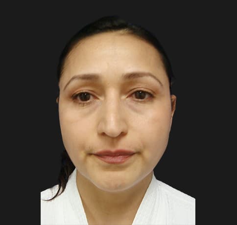 Case 12767 , Performed By Dr. Tehrani – angle 3 Before