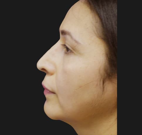 Case 12767 , Performed By Dr. Tehrani – angle 2 After