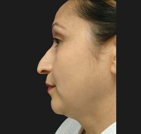 Case 12767 , Performed By Dr. Tehrani – angle 2 Before