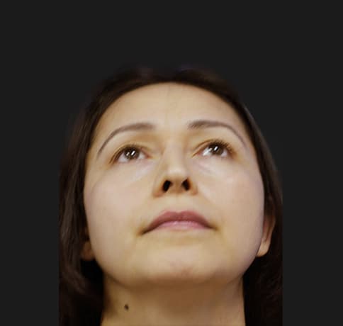 Case 12767 , Performed By Dr. Tehrani – angle 4 After