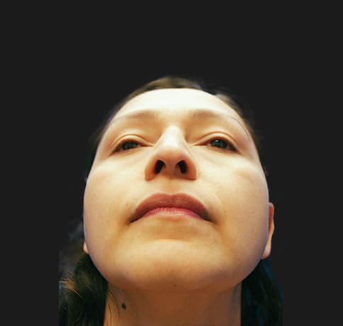 Case 12767 , Performed By Dr. Tehrani – angle 4 Before