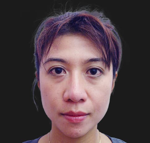 Case 8805 , Performed By Dr. Tehrani – angle 3 After