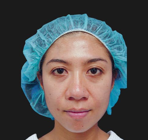 Case 8805 , Performed By Dr. Tehrani – angle 3 Before