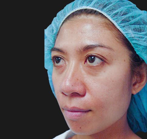 Case 8805 , Performed By Dr. Tehrani – angle 4 Before