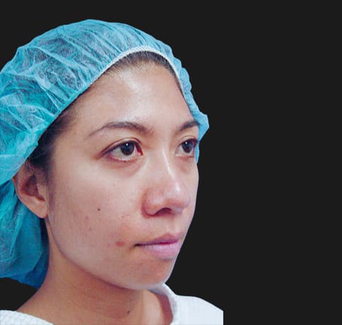 Case 8805 , Performed By Dr. Tehrani – angle 5 Before