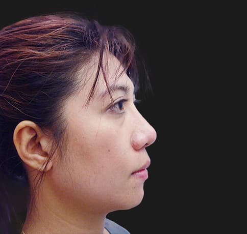 Case 8805 , Performed By Dr. Tehrani – After