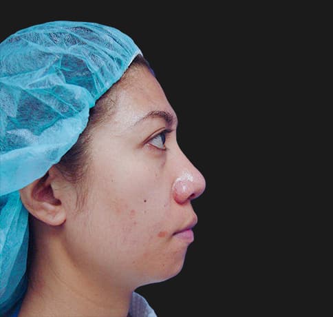 Case 8805 , Performed By Dr. Tehrani – Before