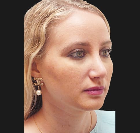 Case 36917 , Performed By Dr. Tehrani – angle 4 After