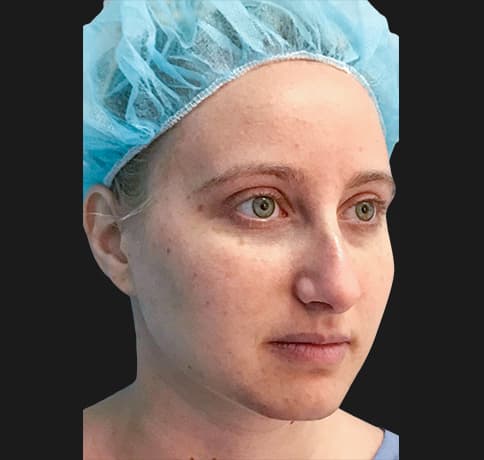 Case 36917 , Performed By Dr. Tehrani – angle 4 Before