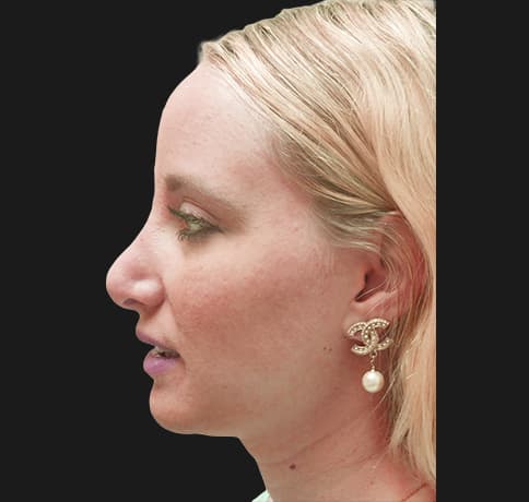 Case 36917 , Performed By Dr. Tehrani – angle 2 After