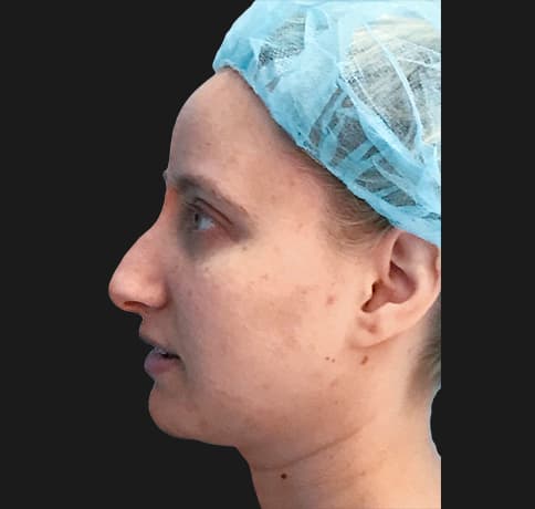 Case 36917 , Performed By Dr. Tehrani – angle 2 Before