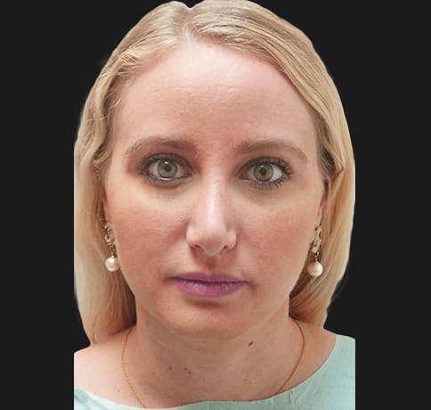 Case 36917 , Performed By Dr. Tehrani – angle 3 After