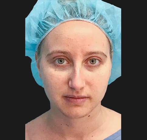 Case 36917 , Performed By Dr. Tehrani – angle 3 Before