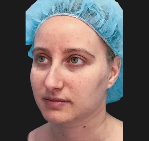 Case 36917 , Performed By Dr. Tehrani – angle 5 Before