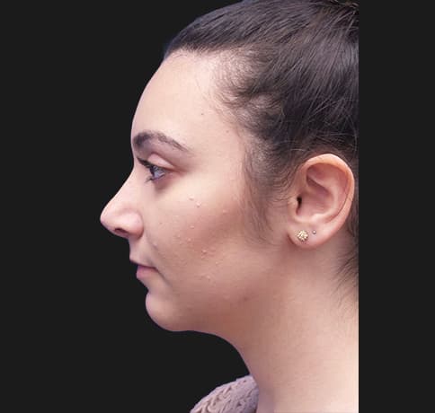 Case 38937 , Performed By Dr. Tehrani – angle 2 After