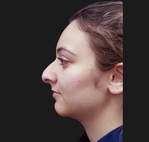 Case 38937 , Performed By Dr. Tehrani – angle 2 Before
