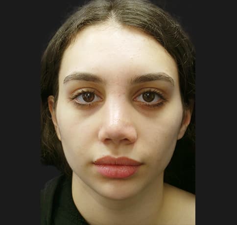 Case 38987 , Performed By Dr. Tehrani – angle 3 After