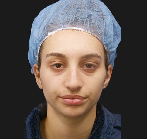 Case 38987 , Performed By Dr. Tehrani – angle 3 Before