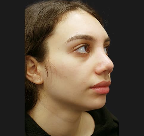 Case 38987 , Performed By Dr. Tehrani – After