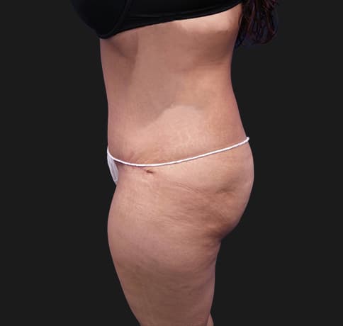Case 28615, Performed By Dr. Tehrani – angle 3 After