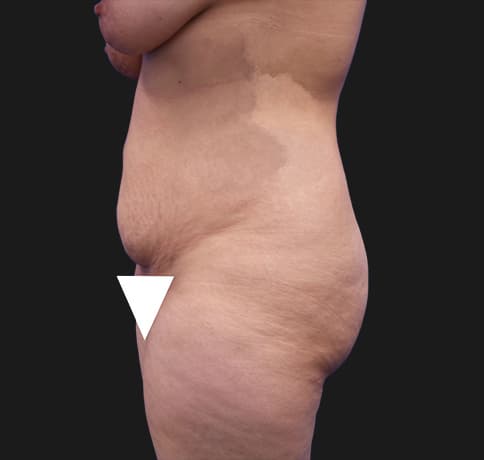 Case 28615, Performed By Dr. Tehrani – angle 3 Before