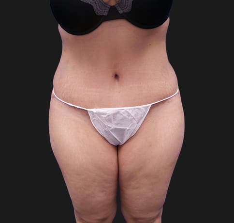 Case 28615, Performed By Dr. Tehrani – After