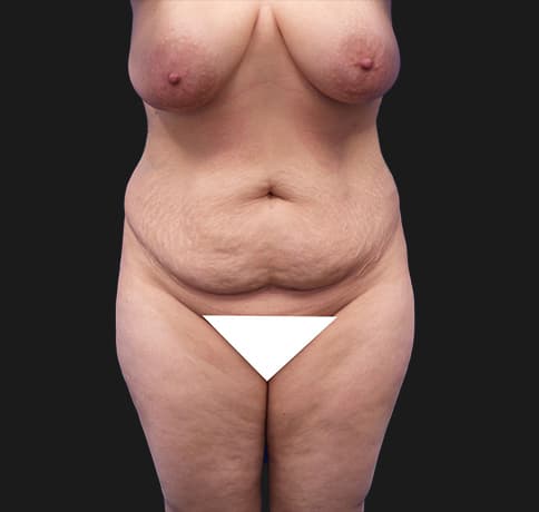 Case 28615, Performed By Dr. Tehrani – Before