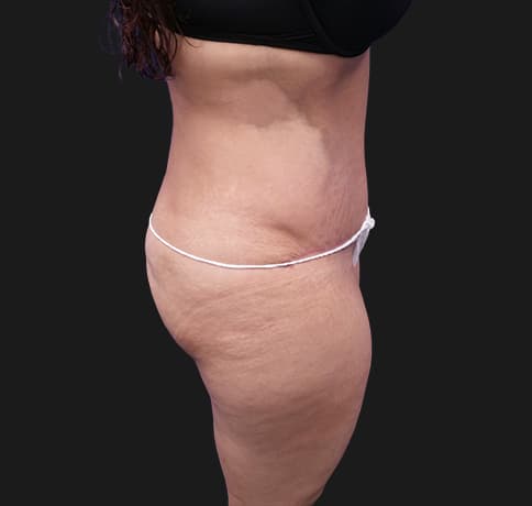 Case 28615, Performed By Dr. Tehrani – angle 2 After