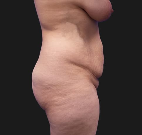 Case 28615, Performed By Dr. Tehrani – angle 2 Before