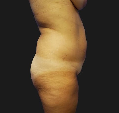 Case 18082, Performed By Dr. Tehrani – Before