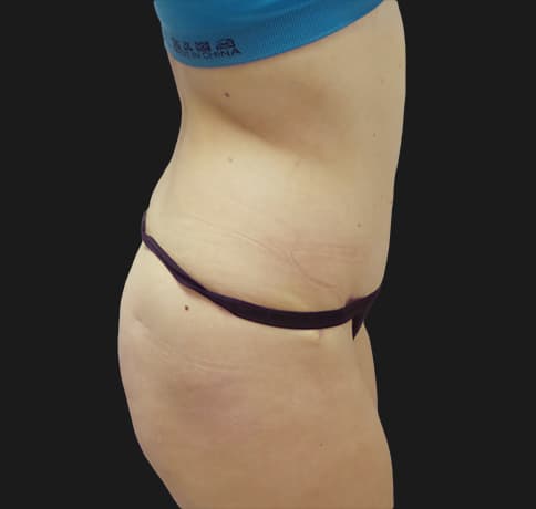 Case 37833, Performed By Dr. Tehrani – angle 2 After