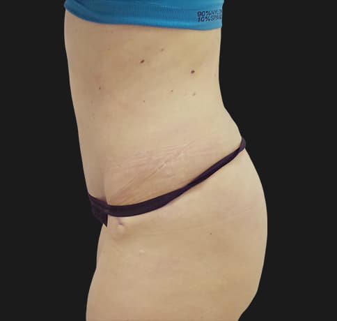 Case 37833, Performed By Dr. Tehrani – angle 3 After