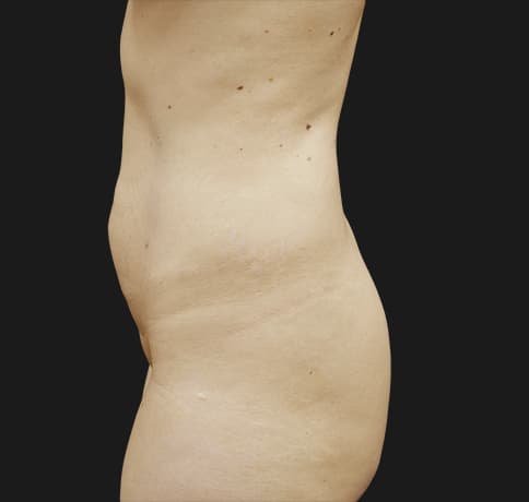 Case 37833, Performed By Dr. Tehrani – angle 3 Before