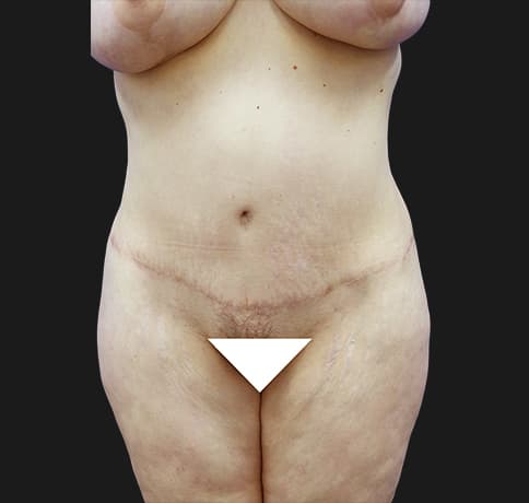 Case 31626, Performed By Dr. Tehrani – After