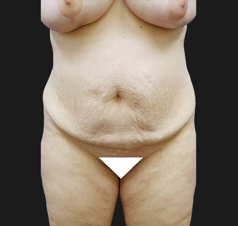 Case 31626, Performed By Dr. Tehrani – Before