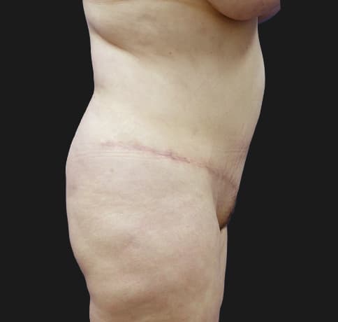 Case 31626, Performed By Dr. Tehrani – angle 2 After