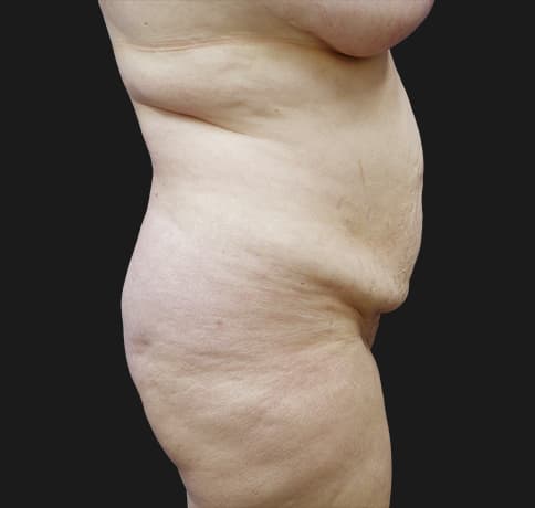 Case 31626, Performed By Dr. Tehrani – angle 2 Before