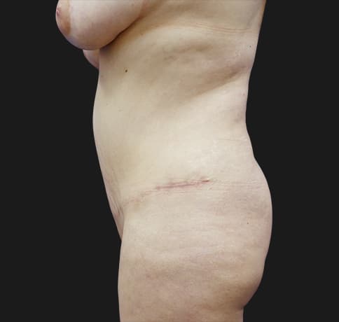 Case 31626, Performed By Dr. Tehrani – angle 3 After