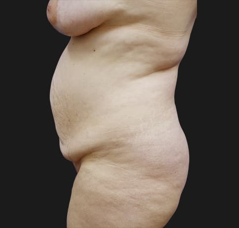 Case 31626, Performed By Dr. Tehrani – angle 3 Before
