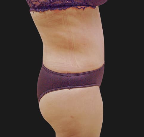 Case 7866, Performed By Dr. Tehrani – angle 2 After