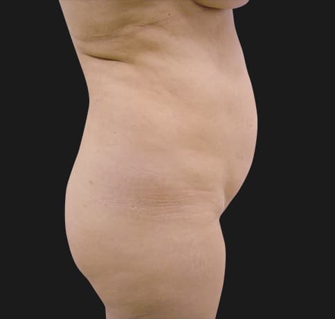 Case 7866, Performed By Dr. Tehrani – angle 2 Before