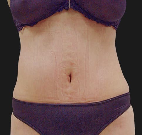 Case 7866, Performed By Dr. Tehrani – After