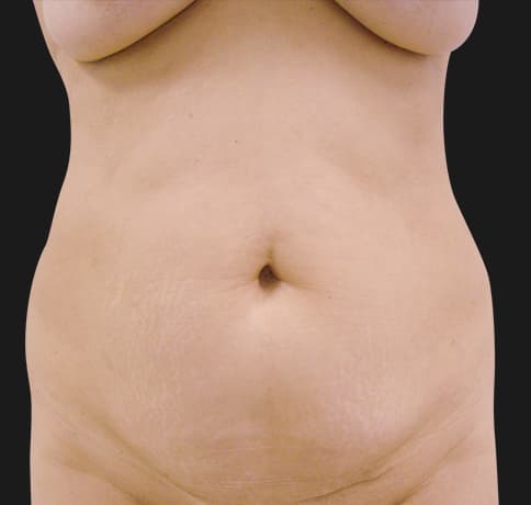 Case 7866, Performed By Dr. Tehrani – Before