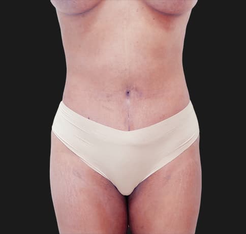 Case 31825, Performed By Dr. Tehrani – After